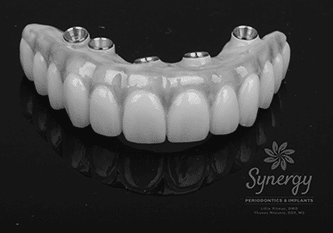 Dental implant process