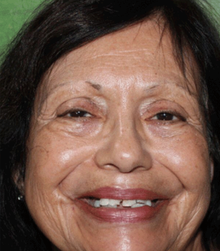 Before & after | patient results 12 Before dental implants