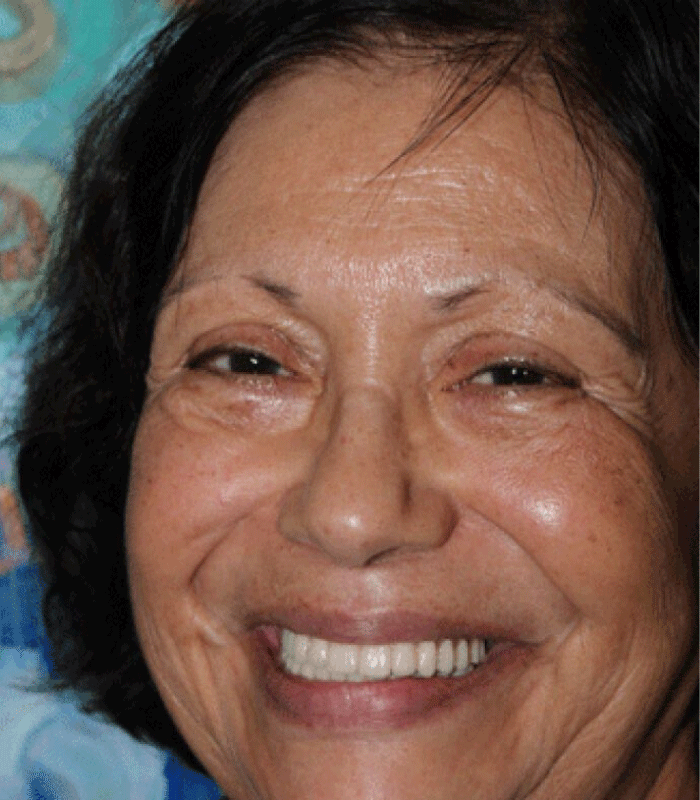 Before & after | patient results 13 Best dental implants doctor fredericksburg va