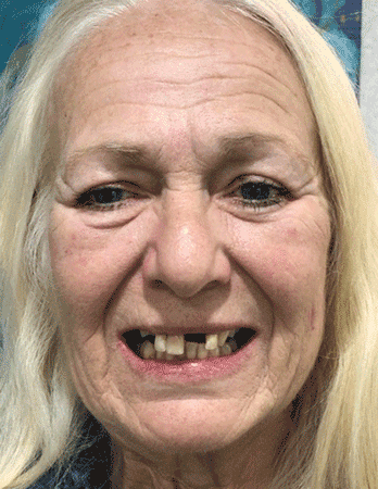 before photo of patient who needs teeth replacement