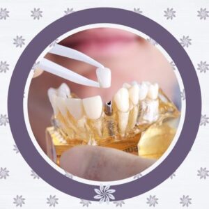 Dental implants? Consider transitioning from dentures 2 Dental implants