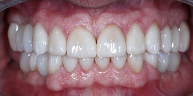 Before & after | patient results 5 Synergy periodontics after front teeth photo smile transformation results