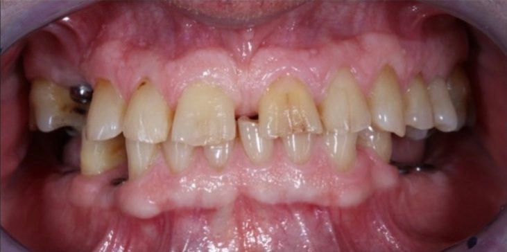 Before & after | patient results 4 Synergy periodontics before front teeth photo smile transformation