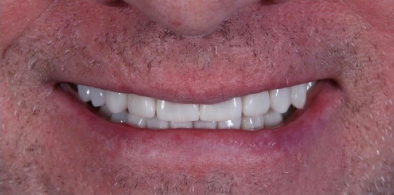 Synergy periodontics and implants | restorative dentistry | fredericksburg va 7 Synergy periodontics after transformation smile results