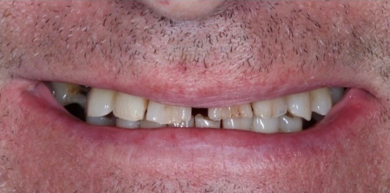 Synergy periodontics and implants | restorative dentistry | fredericksburg va 6 Synergy periodontics before transformation smile