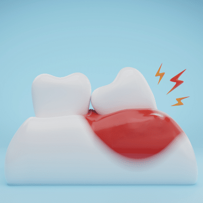Illustration of periodontal disease