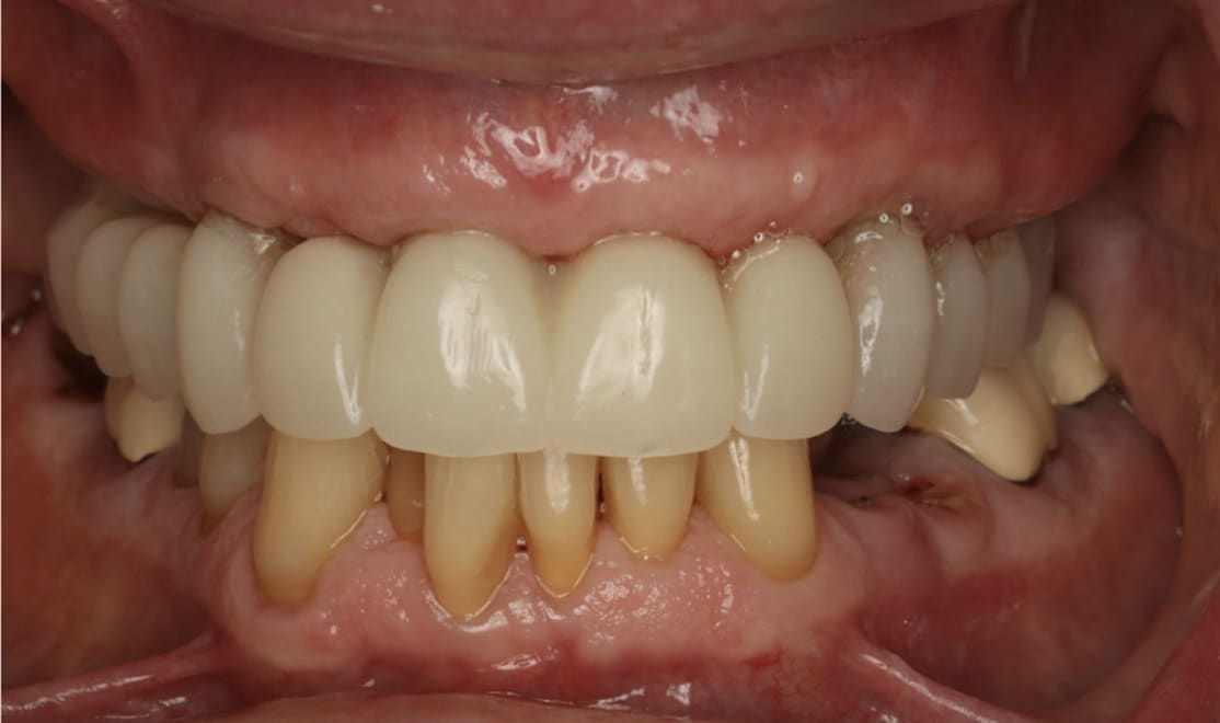 Extractions and immediate implants