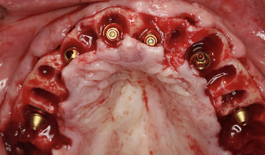 Extractions and immediate implants