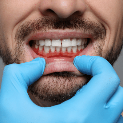 Gloved hand holding man's lip down showing gums, representing preventing gum disease