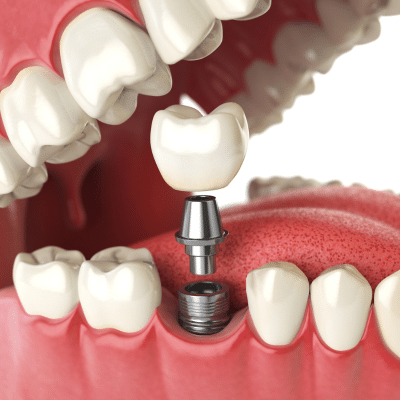 Illustration of dental implants