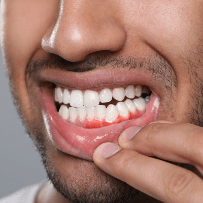 Person holding lip down and showing gum, representing gum health